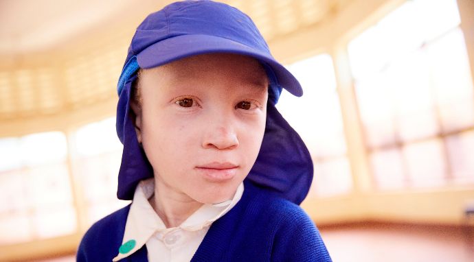 Niña con albinismo usando un gorro con protección solar